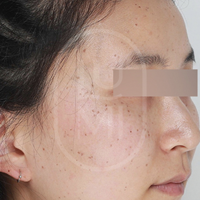 pigmentation removal before