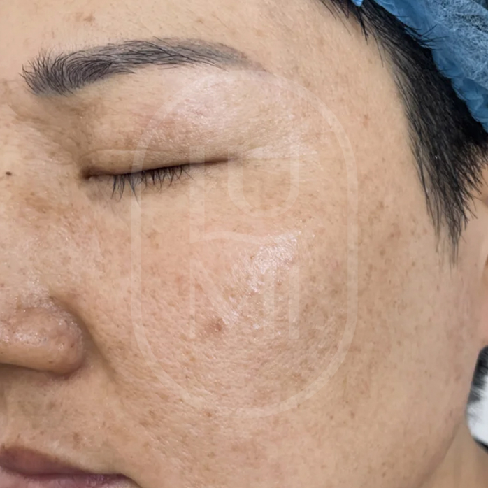 pigmentation removal before1