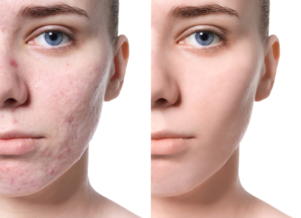 Young woman before and after acne treatment on a white background.