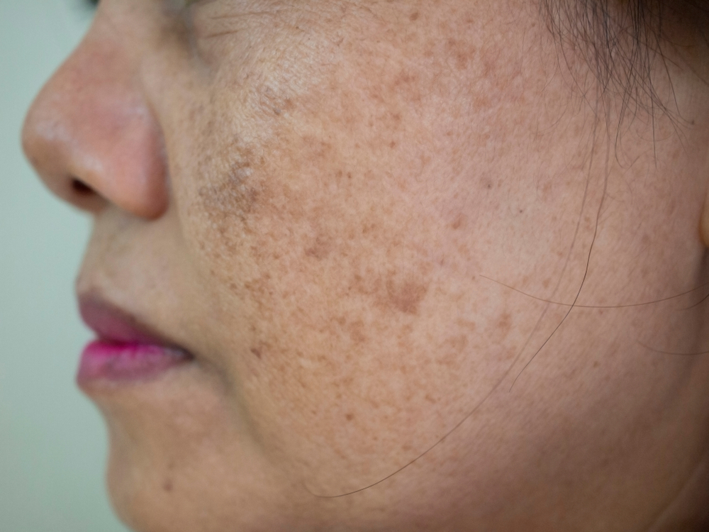 The problem of dark spots melasma pigmentation, on the face of asian woman.
