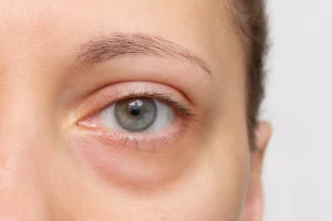The face of a young woman with a bag under her eye close-up